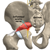 Sciatica